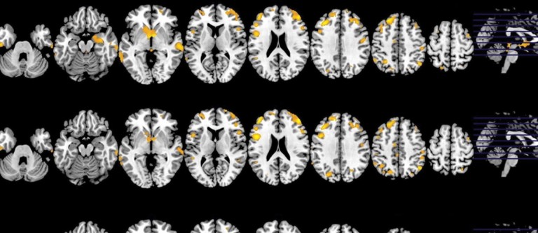 NF-Mar1 Preventing Parkinson's Disease With Diet
