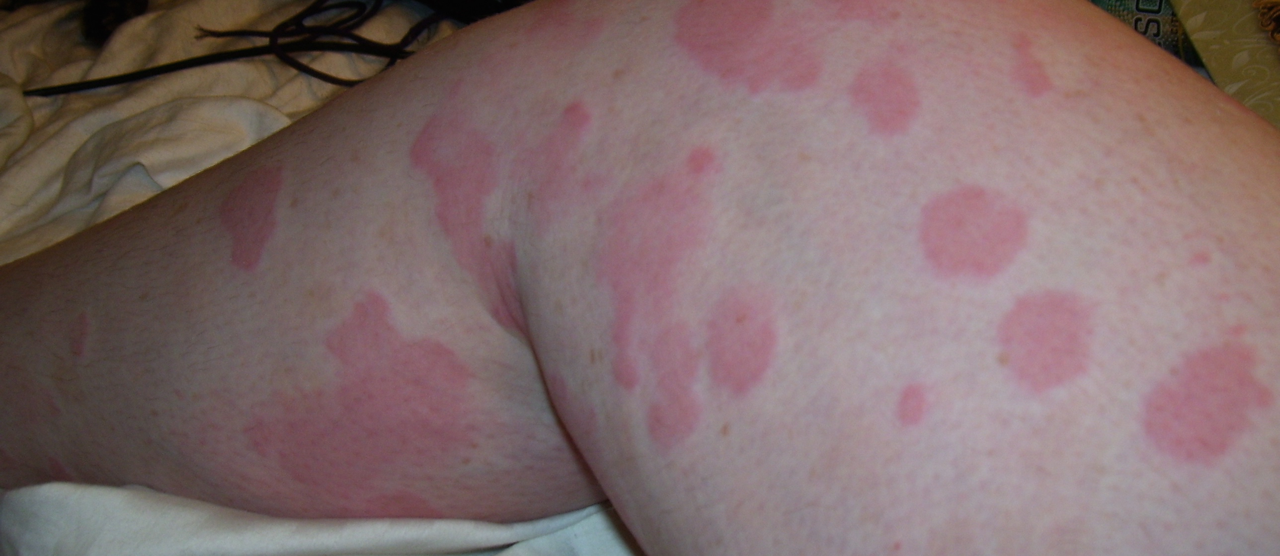 Hives from Tick BiteInduced Meat Allergies